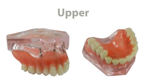 LD Study Model Overdenture with 4 Implants - Upper - LD-094